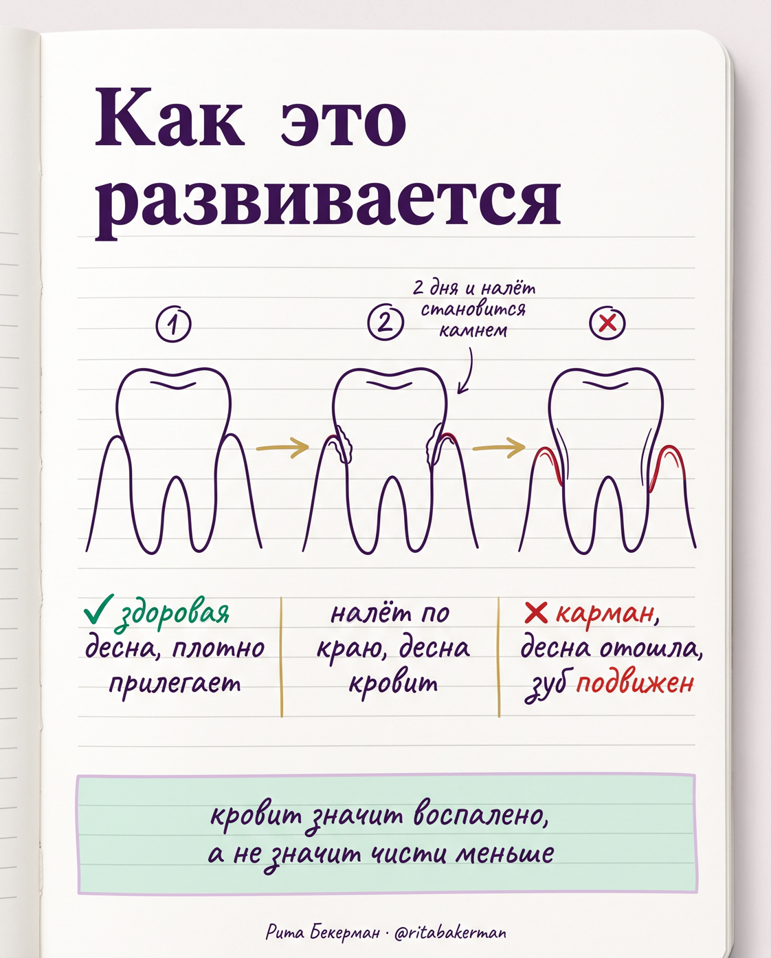 От налёта до кармана: как гингивит превращается в пародонтит