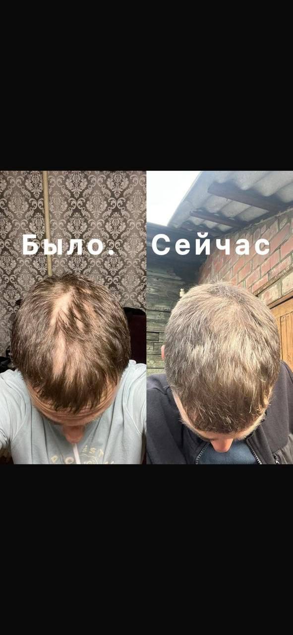 Гнёздная алопеция: Волосы выросли