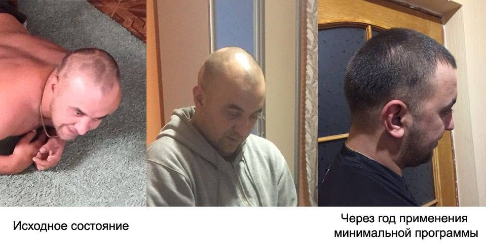 Дилшод: Выросли новые волосы