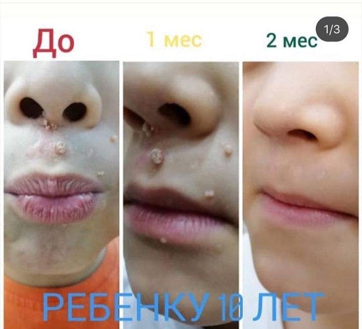Мальчик, 10 лет: Папилломы ушли за два месяца