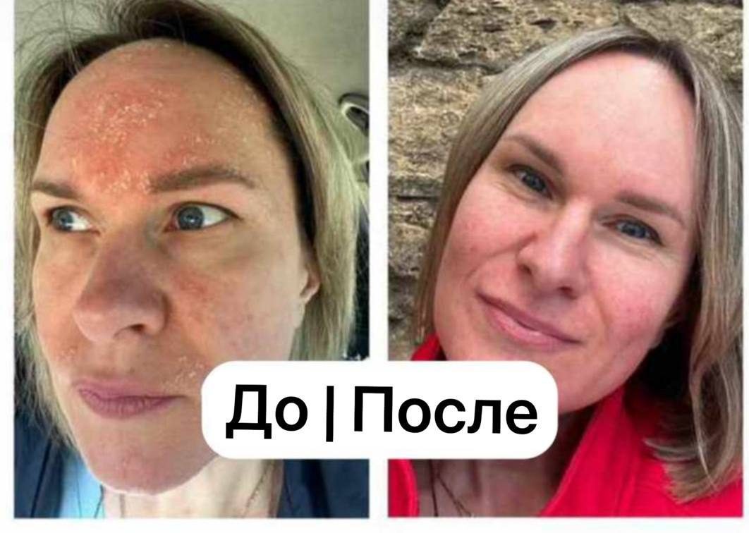 25 лет на гормональных мазях: Себорейный дерматит: мази отправились в ведро