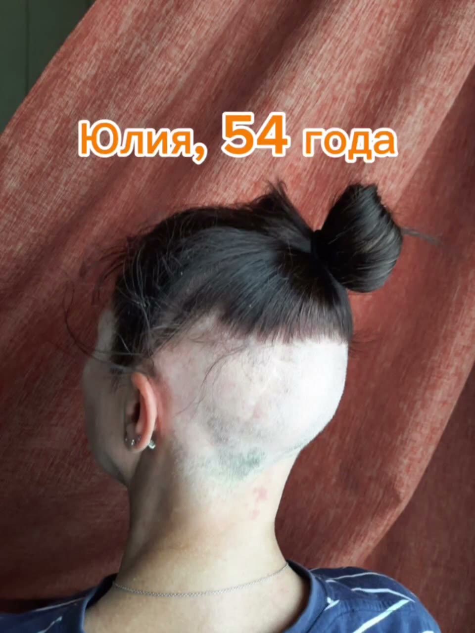 Юлия: Хроническое облысение: мастер не видит лысин